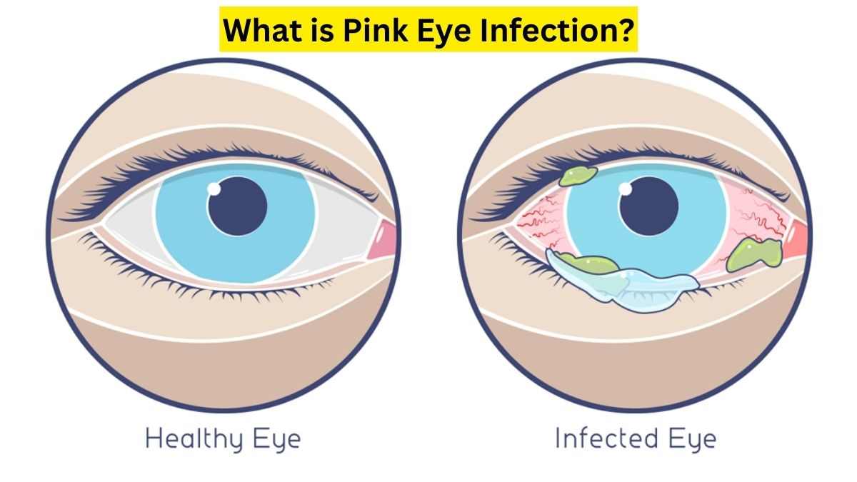 All About Pink Eye Infection